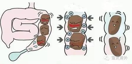 其他慢性疾病,体内缺水,药物因素等等,并不是每一种都适合用开塞露